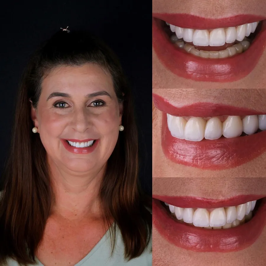 Paciente da Cantelli Odontologia sorrindo depois do tratamento, com detalhes das lentes de contato dental