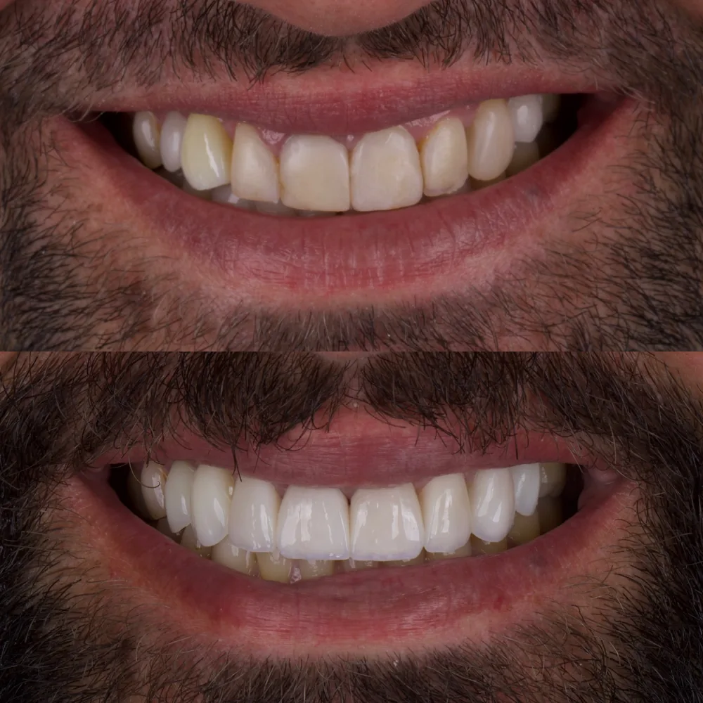 Resultado de lentes de contato dental, caso 1