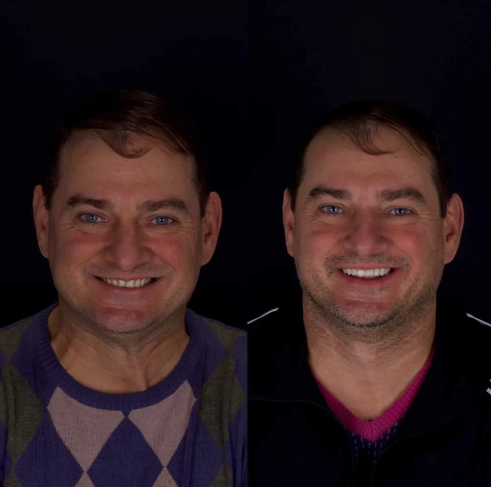 Resultado de lentes de contato dental, caso 5