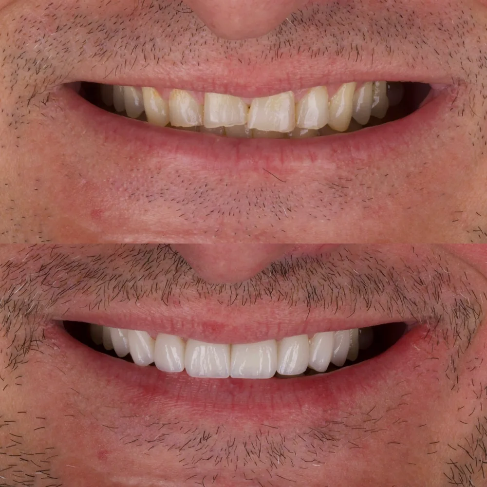 Resultado de lentes de contato dental, caso 6