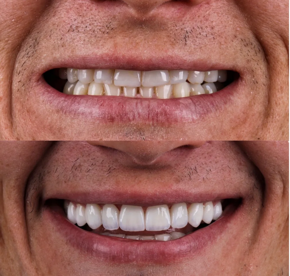 Resultado de lentes de contato dental, caso 8