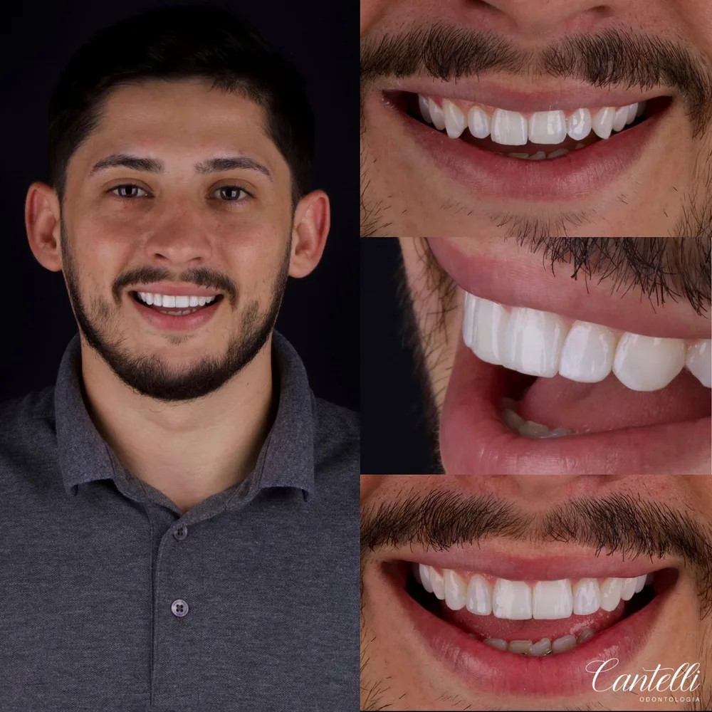 Resultado de lentes de contato dental, caso 10