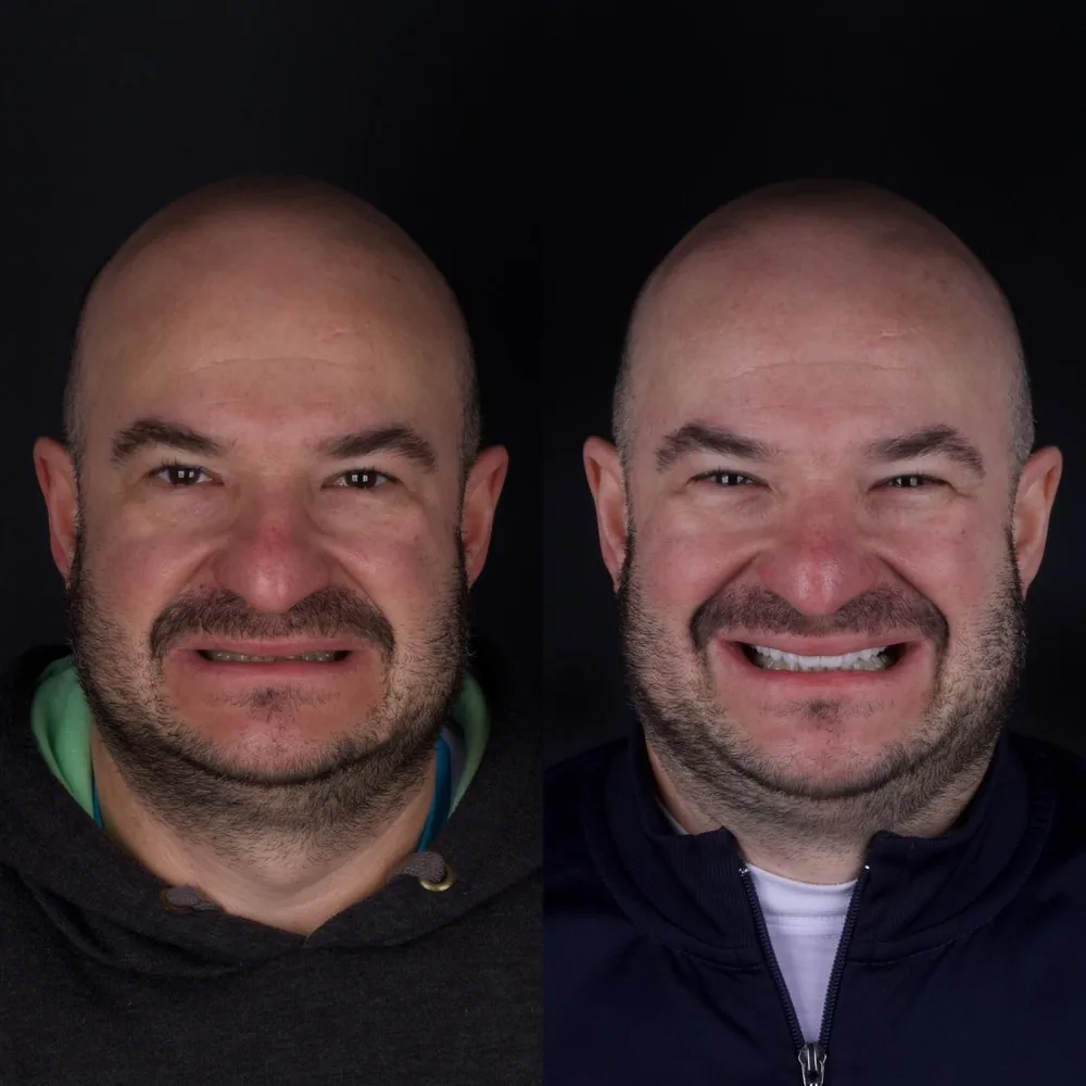 Resultado de lentes de contato dental, caso 13