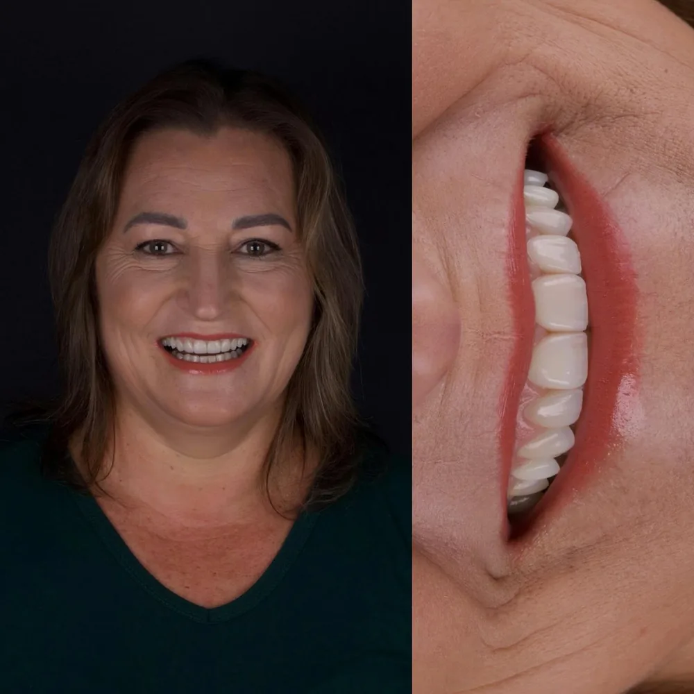 Resultado de lentes de contato dental, caso 14