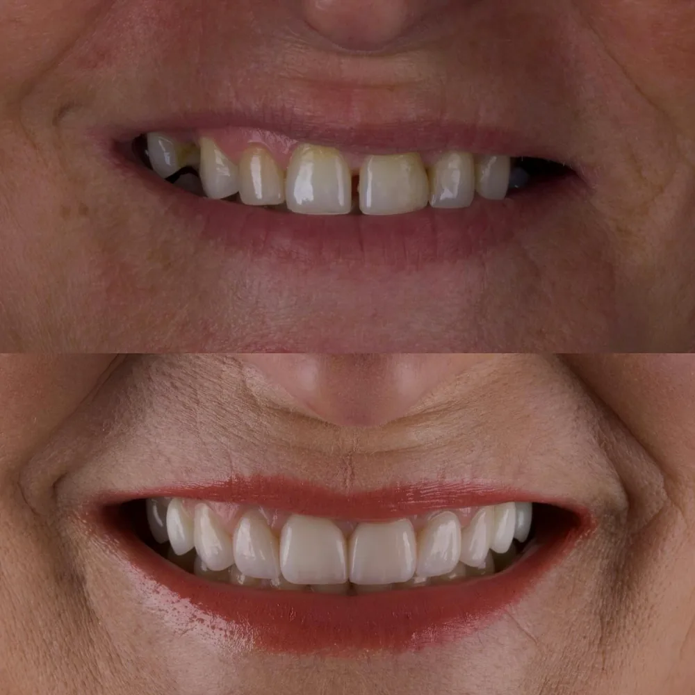 Resultado de lentes de contato dental, caso 15