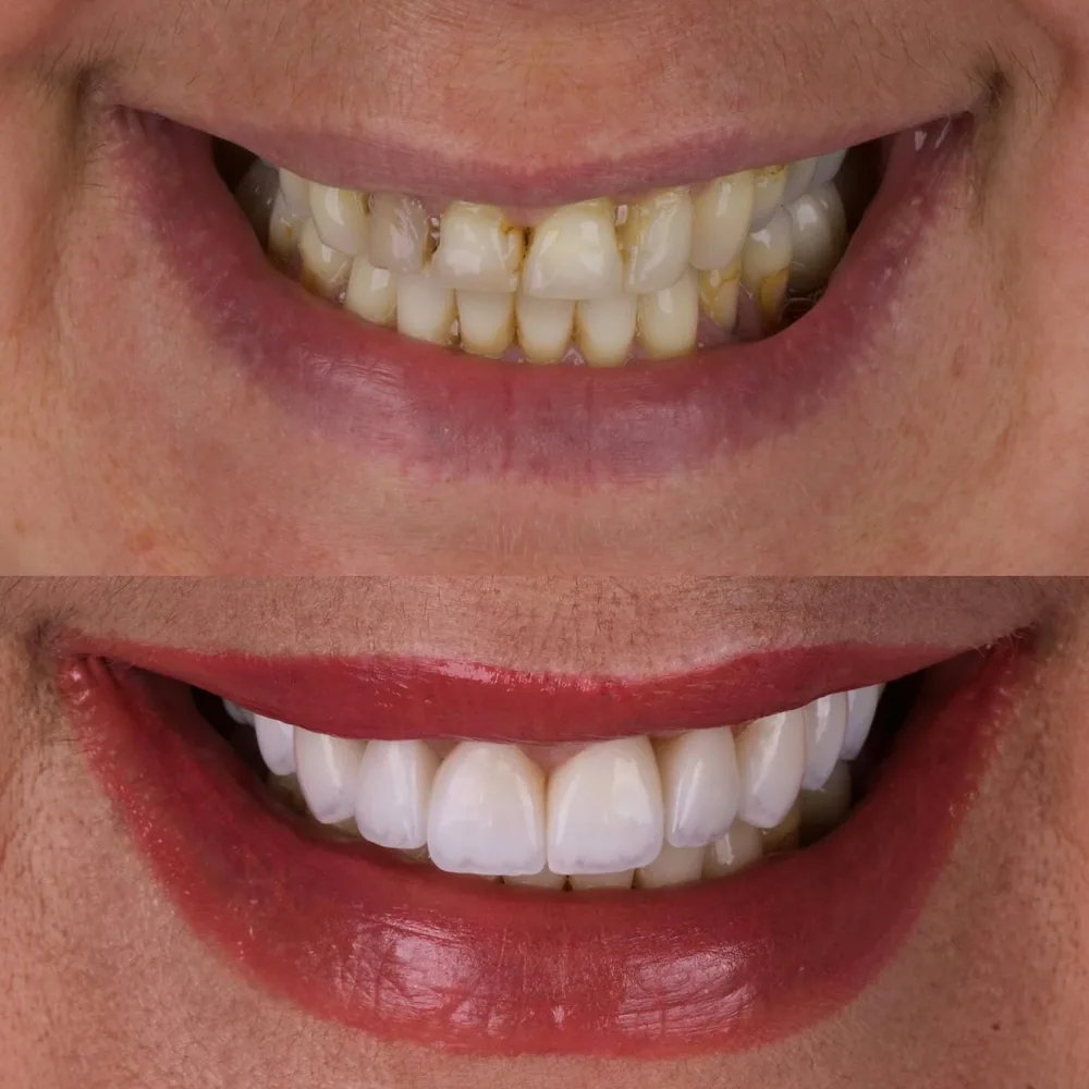 Resultado de lentes de contato dental, caso 17
