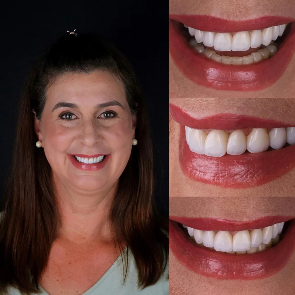 Resultado de lentes de contato dental, caso 18