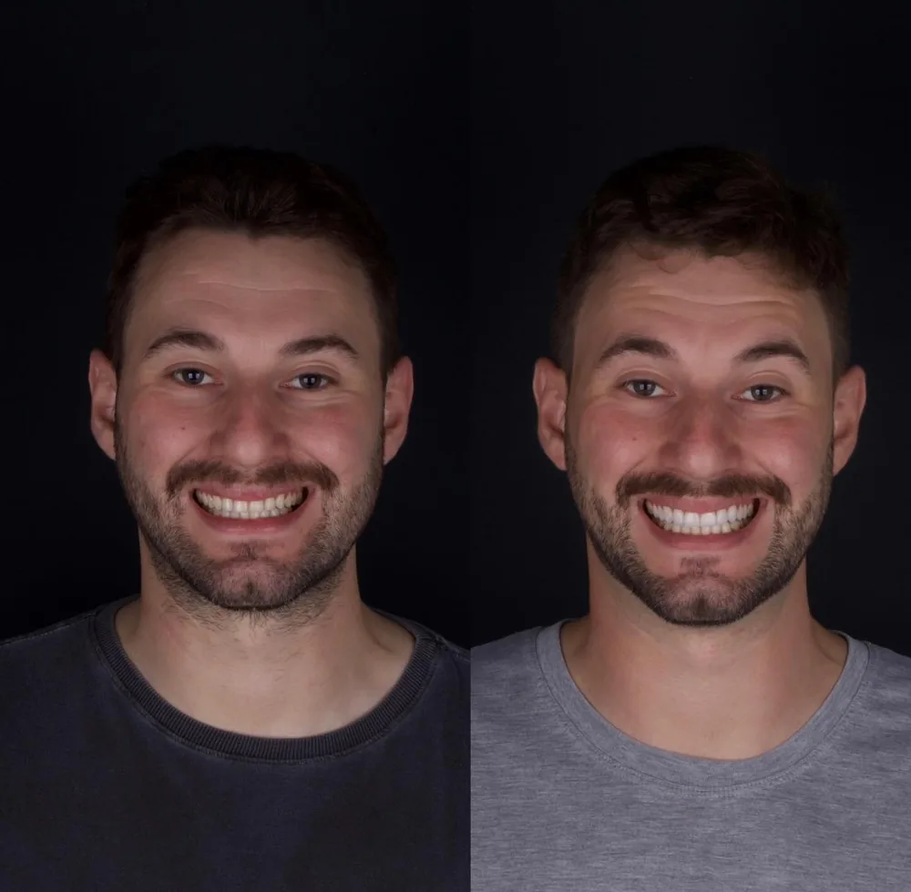 Resultado de lentes de contato dental, caso 19