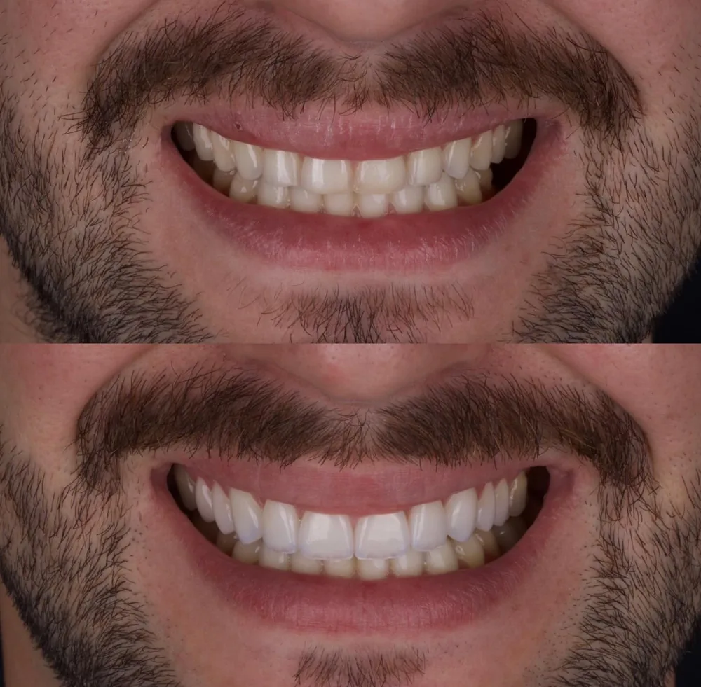 Resultado de lentes de contato dental, caso 20